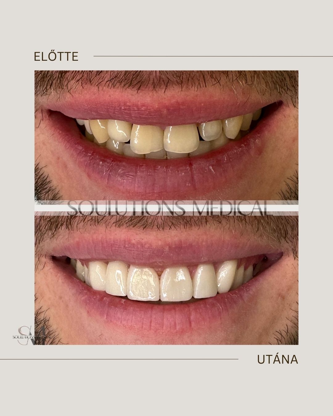 Beige Brown Neutral Before + After Poster.zip - 1