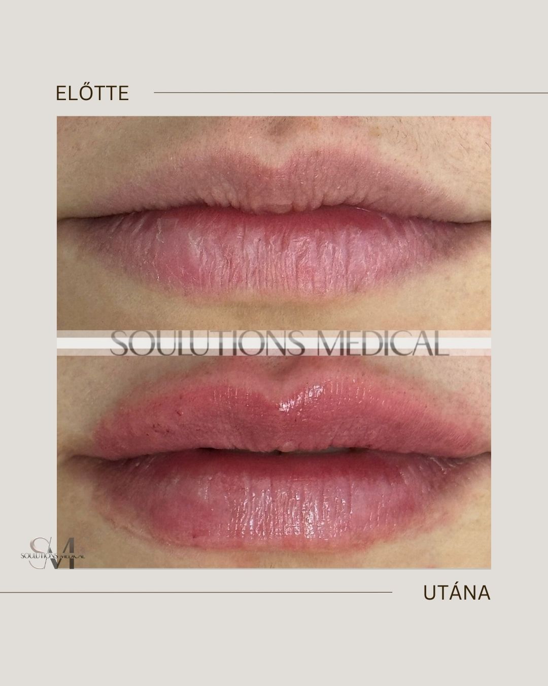 Beige Brown Neutral Before + After Poster.zip - 11