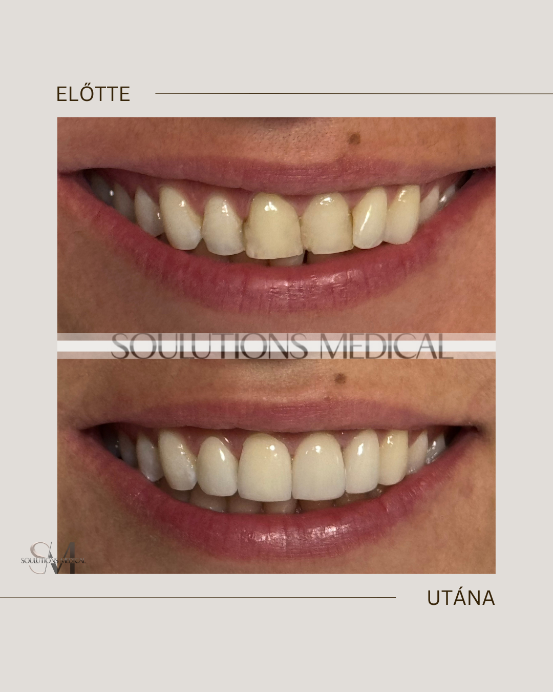 Beige Brown Neutral Before + After Poster.zip - 1hej