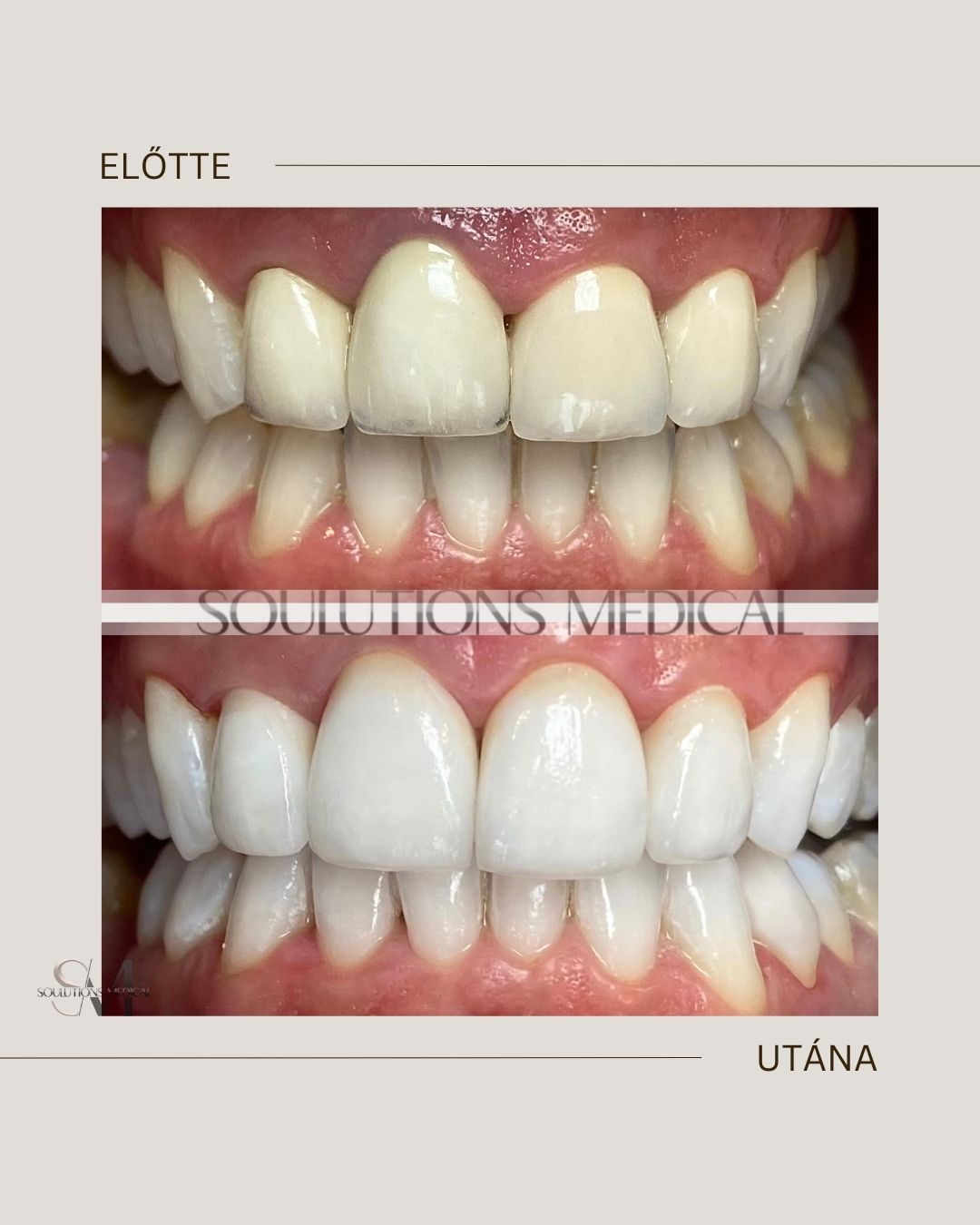 Beige Brown Neutral Before + After Poster.zip - 2