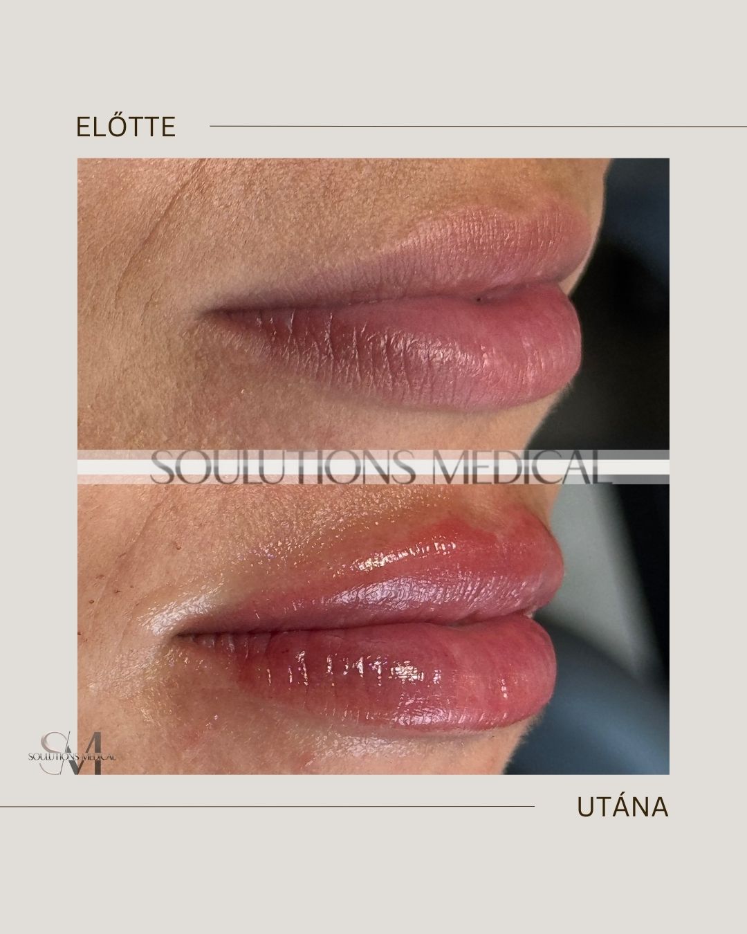 Beige Brown Neutral Before + After Poster.zip - 3