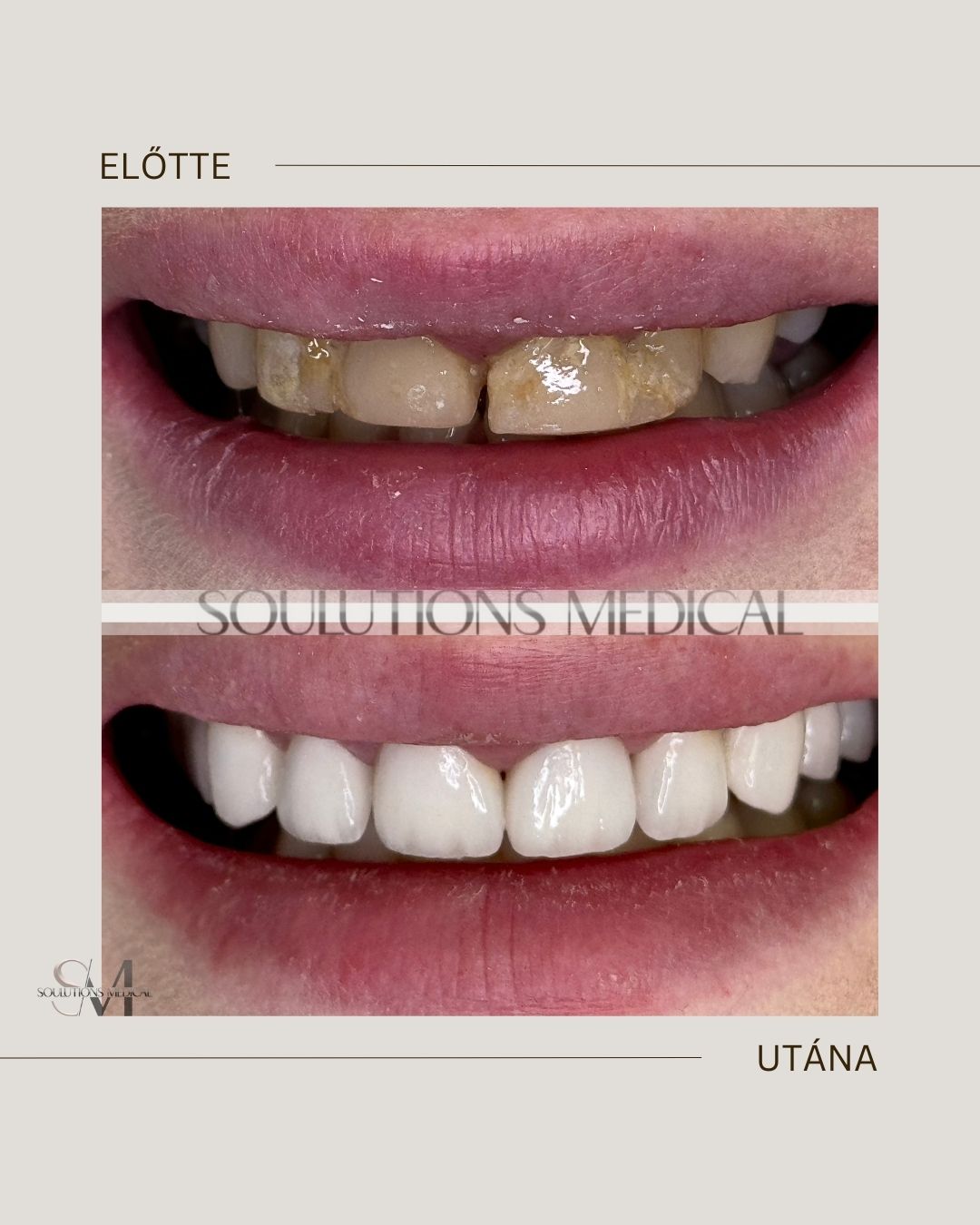 Beige Brown Neutral Before + After Poster.zip - 3