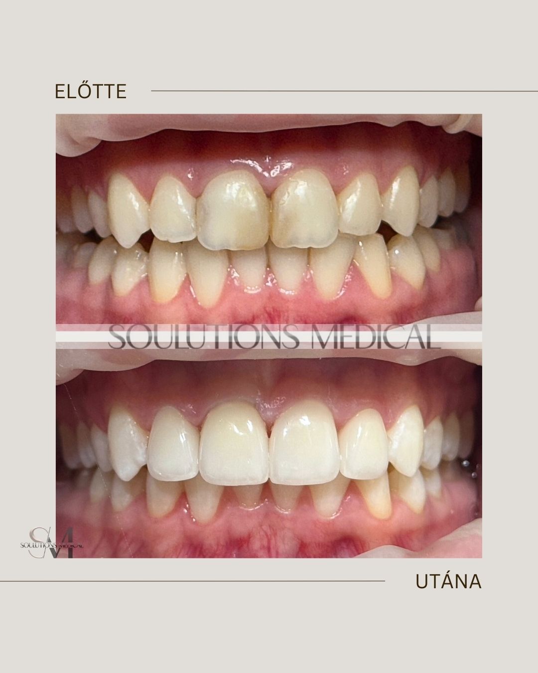 Beige Brown Neutral Before + After Poster.zip - 4