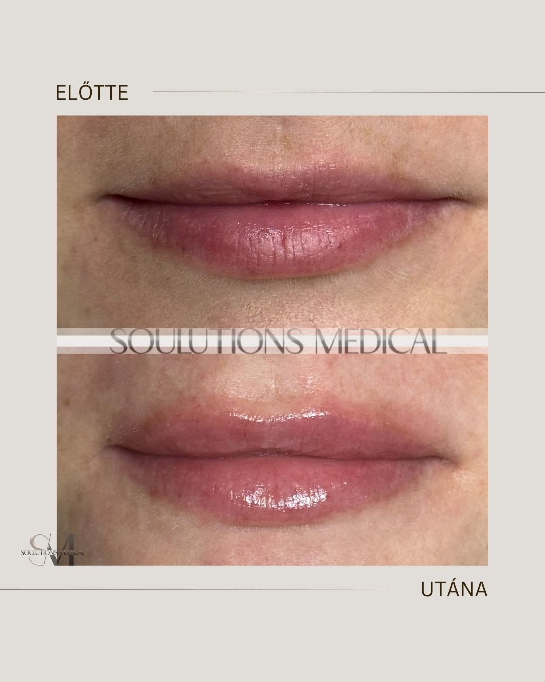 Beige Brown Neutral Before + After Poster.zip - 5