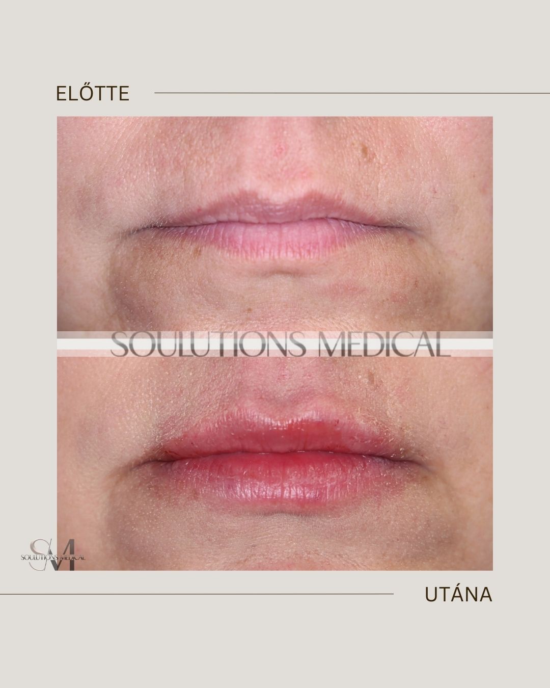 Beige Brown Neutral Before + After Poster.zip - 9