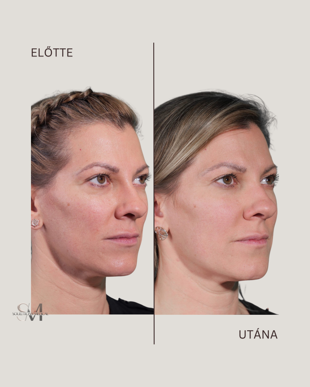 Brown Abstract Simple Photo Before and After Skincare Instagram Post - 3