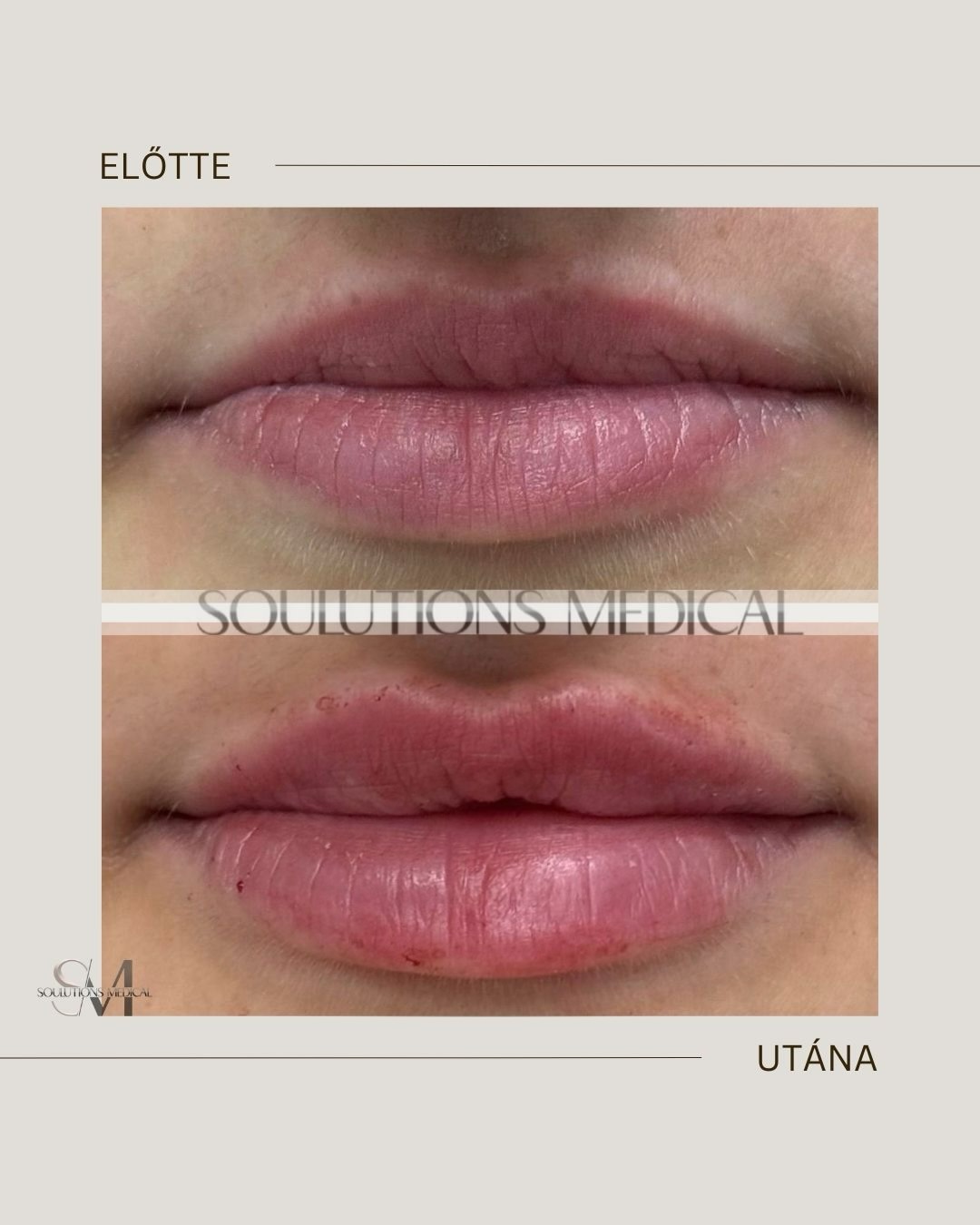 Beige Brown Neutral Before + After Poster - 15