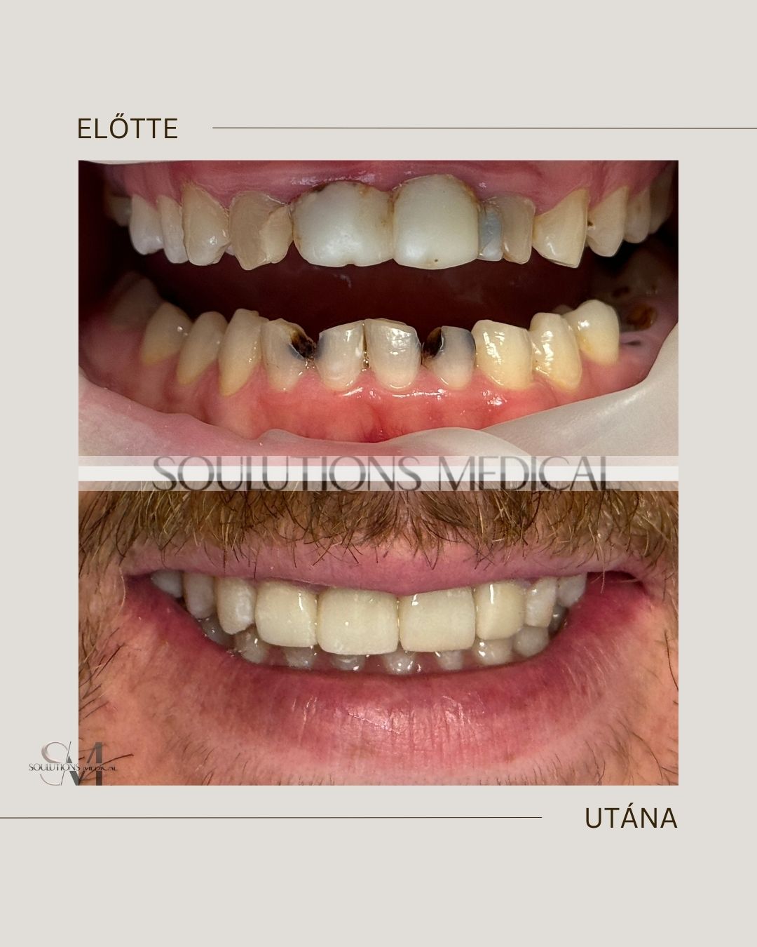 Beige Brown Neutral Before + After Poster - 2