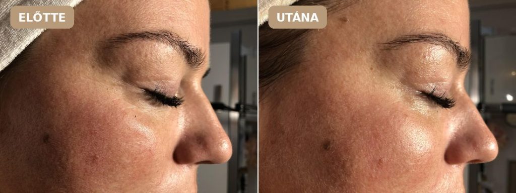 Revitalize előtte–utána: Revitalize Pure