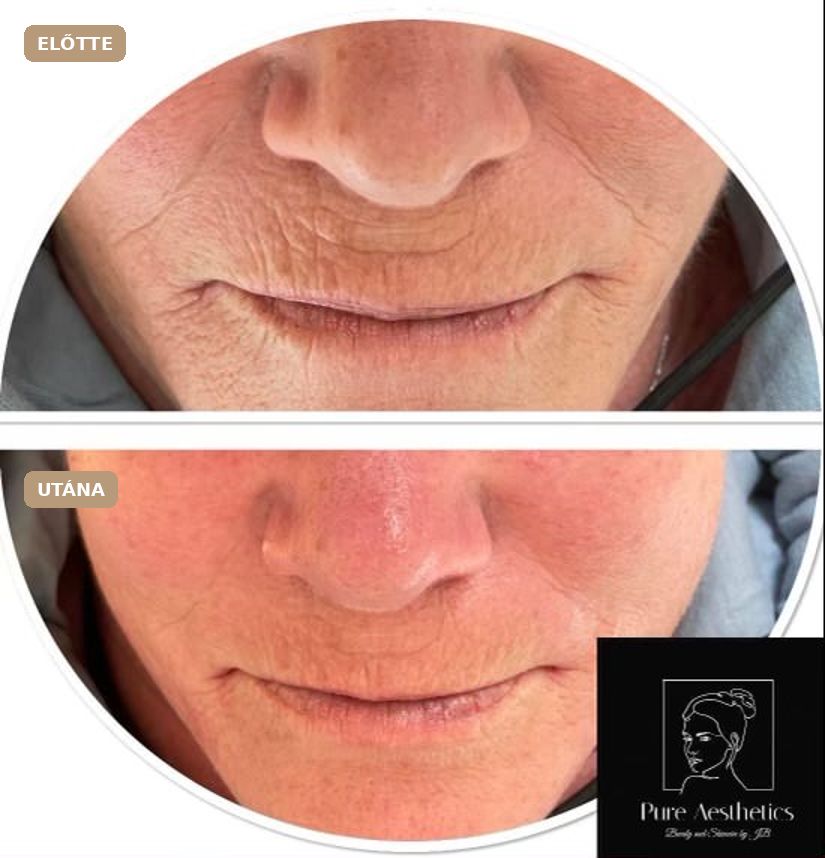 Revitalize előtte–utána: Revitalize Pure