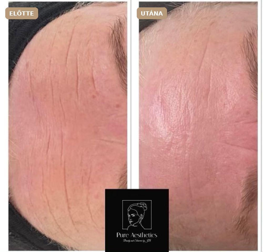 Revitalize előtte–utána: Revitalize Pure