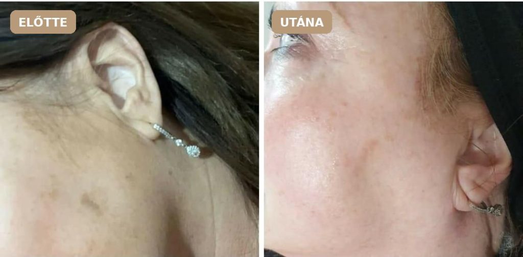 Revitalize előtte–utána: Revitalize Pure