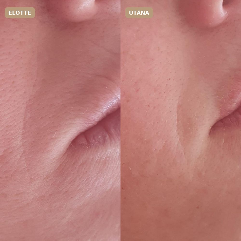 Revitalize előtte–utána: Revitalize Pure