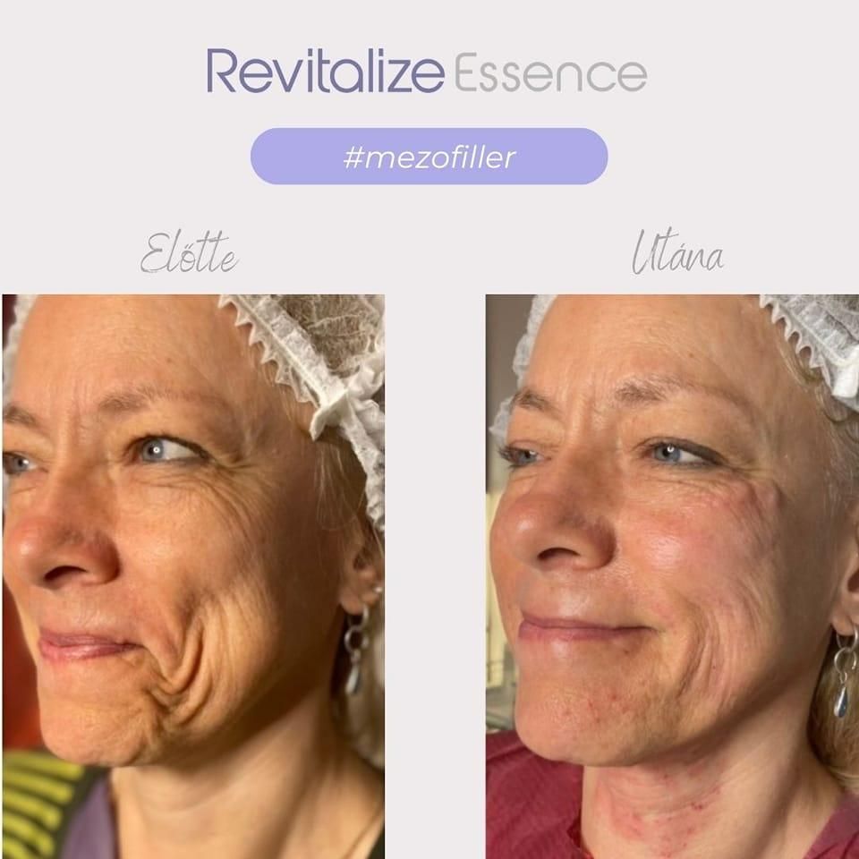 Revitalize előtte–utána: Revitalize Essence